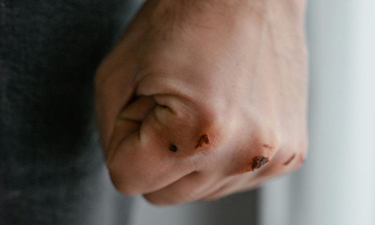Punho de homem fechado com alguns ferimentos, exemplificando clientes abusivos no Trabalho Sexual.